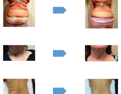 Northampton Cavitation Liposuction